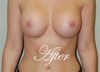 Breast Augmentation | Mommy Makeover