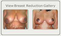 breast reduc thumb
