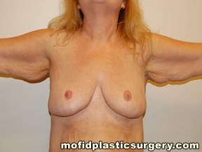 Arm Lift Case 1558 Before Photo Arm Lift