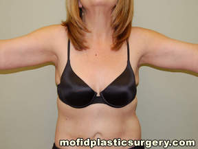 Arm Lift Case 1571 After Photo Arm Lift