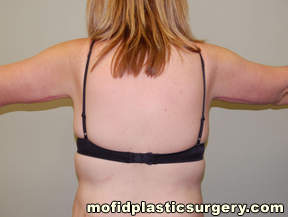Arm Lift Case 1571 After Photo Arm Lift