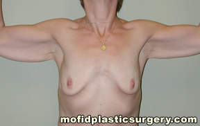 Arm Lift Case 1580 Before Photo Arm Lift