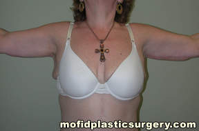Arm Lift Case 1596 After Photo Arm Lift