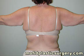 Arm Lift Case 1596 Before Photo Arm Lift