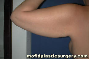 Arm Lift Case 1607 Before Photo Arm Lift