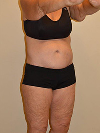 Body Lift Case 1525 After Photo Body Lift
