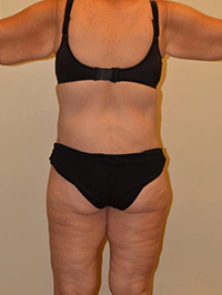 Body Lift Case 1525 After Photo Body Lift
