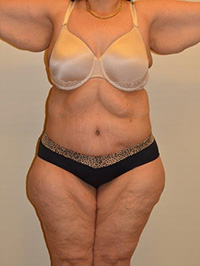 Body Lift Case 1549 After Photo Body Lift