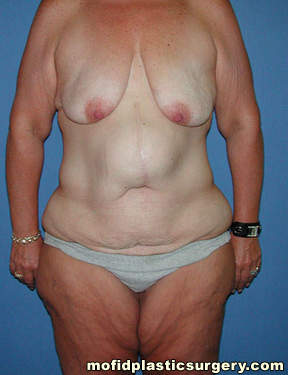 Body Lift Case 1753 Before Photo Body Lift