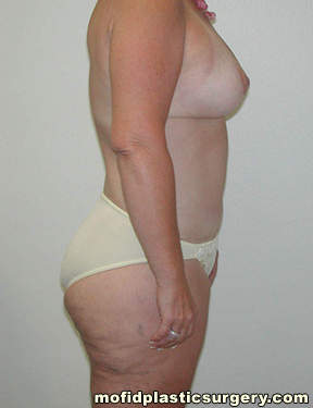 Body Lift Case 1753 After Photo Body Lift