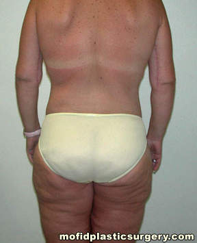 Body Lift Case 1753 After Photo Body Lift