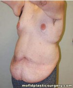 Body Lift