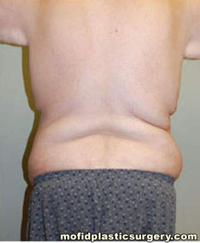 Body Lift Case 1765 Before Photo Body Lift
