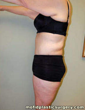 Body Lift Case 1774 After Photo Body Lift