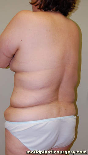 Body Lift Case 1819 Before Photo Body Lift