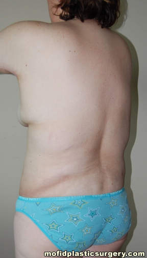 Body Lift Case 1819 After Photo Body Lift