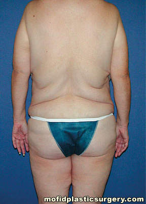 Body Lift Case 1845 Before Photo Body Lift