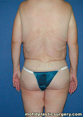 Body Lift Case 1845 After Photo Body Lift