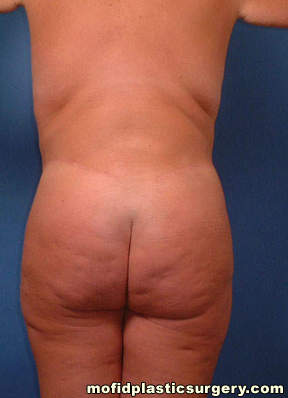 Body Lift Case 1855 After Photo Body Lift