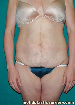 Body Lift Case 1867 Before Photo Body Lift