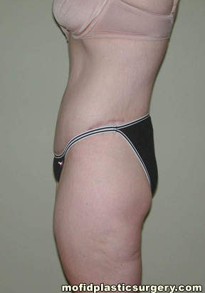 Body Lift Case 1867 After Photo Body Lift