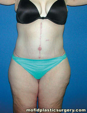 Body Lift Case 1880 After Photo Body Lift