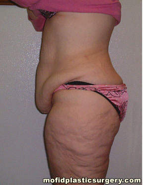 Body Lift Case 1880 Before Photo Body Lift