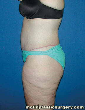 Body Lift Case 1880 After Photo Body Lift