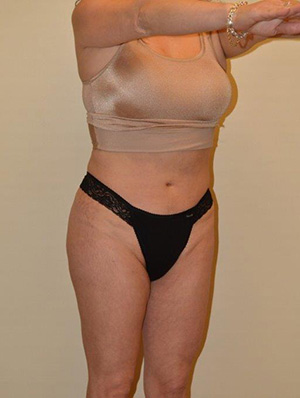 Buttock Augmentation Case 1659 After Photo Buttock Augmentation