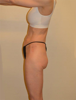 Buttock Augmentation Case 1671 Before Photo Buttock Augmentation