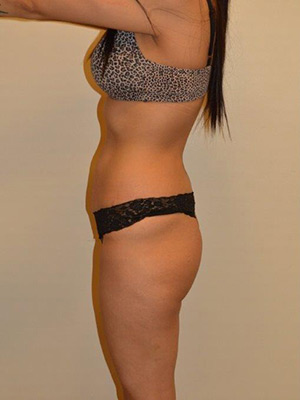 Buttock Augmentation Case 1684 Before Photo Buttock Augmentation