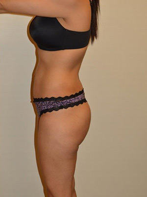 Buttock Augmentation Case 1684 After Photo Buttock Augmentation
