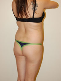Buttock Augmentation Case 1737 Before Photo Buttock Augmentation