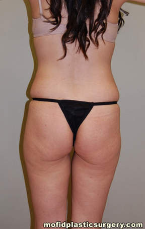 Buttock Augmentation Case 1905 Before Photo Buttock Augmentation