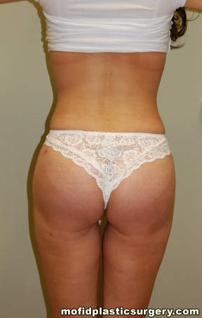 Buttock Augmentation Case 1905 After Photo Buttock Augmentation