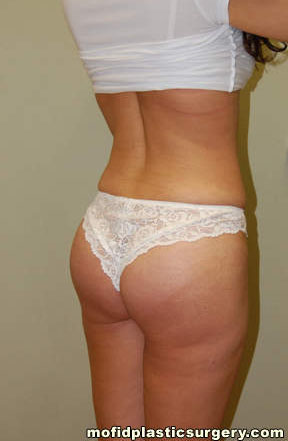 Buttock Augmentation Case 1905 After Photo Buttock Augmentation