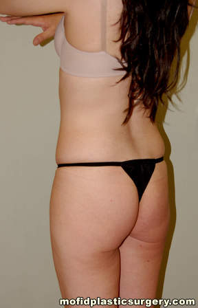Buttock Augmentation Case 1905 Before Photo Buttock Augmentation
