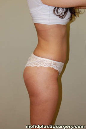 Buttock Augmentation Case 1905 After Photo Buttock Augmentation