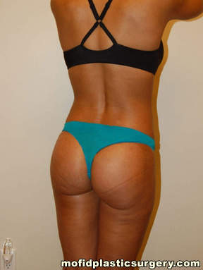 Buttock Augmentation Case 1931 After Photo Buttock Augmentation
