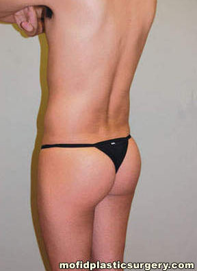Buttock Augmentation Case 1941 After Photo Buttock Augmentation