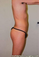 Buttock Augmentation