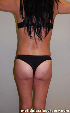 Buttock Augmentation Case 1948 After Photo Buttock Augmentation