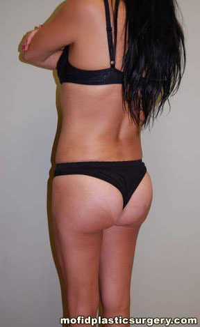 Buttock Augmentation Case 1948 After Photo Buttock Augmentation