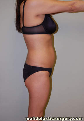 Buttock Augmentation Case 1948 Before Photo Buttock Augmentation