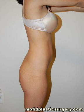 Buttock Augmentation Case 1959 Before Photo Buttock Augmentation