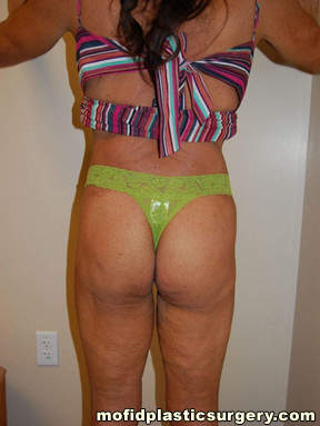 Buttock Augmentation