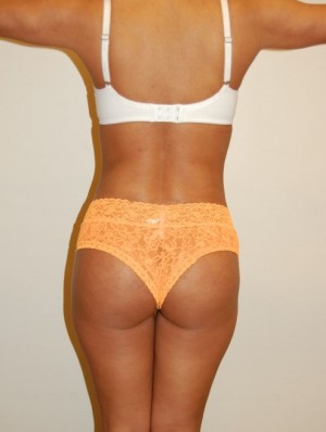 Buttock Augmentation Case 1979 After Photo Buttock Augmentation