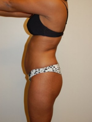 Buttock Augmentation Case 1979 Before Photo Buttock Augmentation