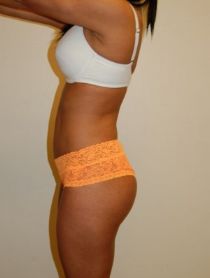 Buttock Augmentation Case 1979 After Photo Buttock Augmentation