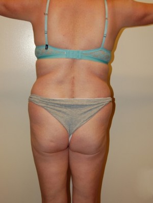 Liposuction Case 2026 Before Photo Liposuction